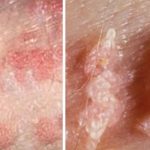 Những Sai Lầm Nghiêm Trọng Gây Ảnh Hưởng Đến Sức Khỏe Khi Điều Trị Sùi Mào Gà 2