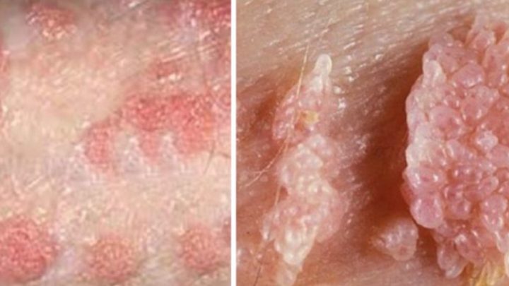 Những Sai Lầm Nghiêm Trọng Gây Ảnh Hưởng Đến Sức Khỏe Khi Điều Trị Sùi Mào Gà 2